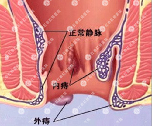 如何防治痔疮发生?