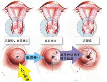 查宫颈炎做哪些检查