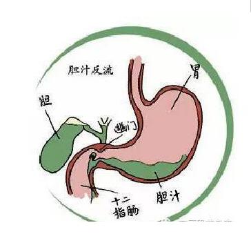 返流性胃炎