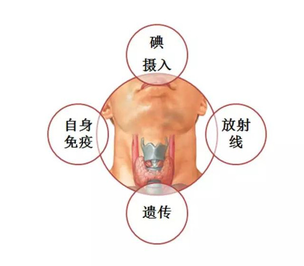 甲状腺结节是由什么原因引起的