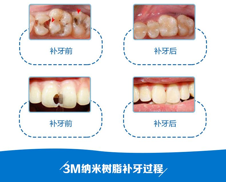 龋齿充填治疗:将龋坏对部分磨除干净,用补牙的树脂材料充填起来.