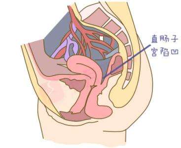 直肠前突病历模板图片