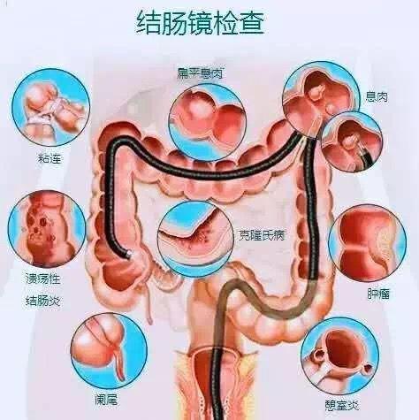 肠结核位置图片
