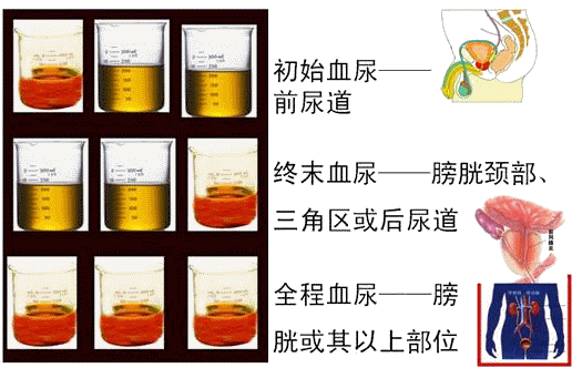 小便血尿怎麼辦